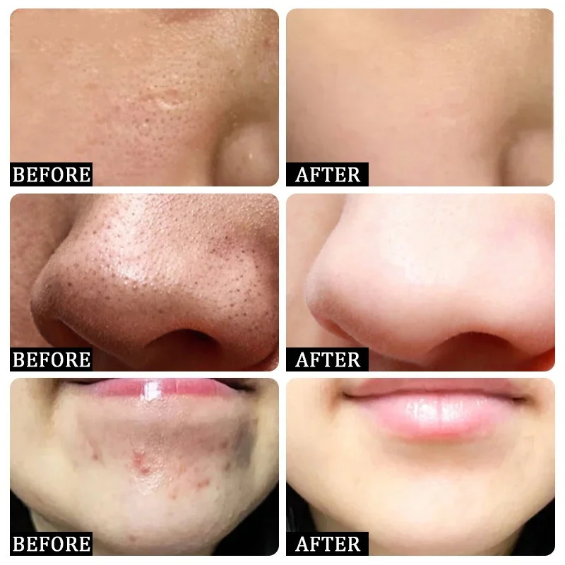 Crème de nettoyage des pores à - Azelaic Acid Cream avis et prix