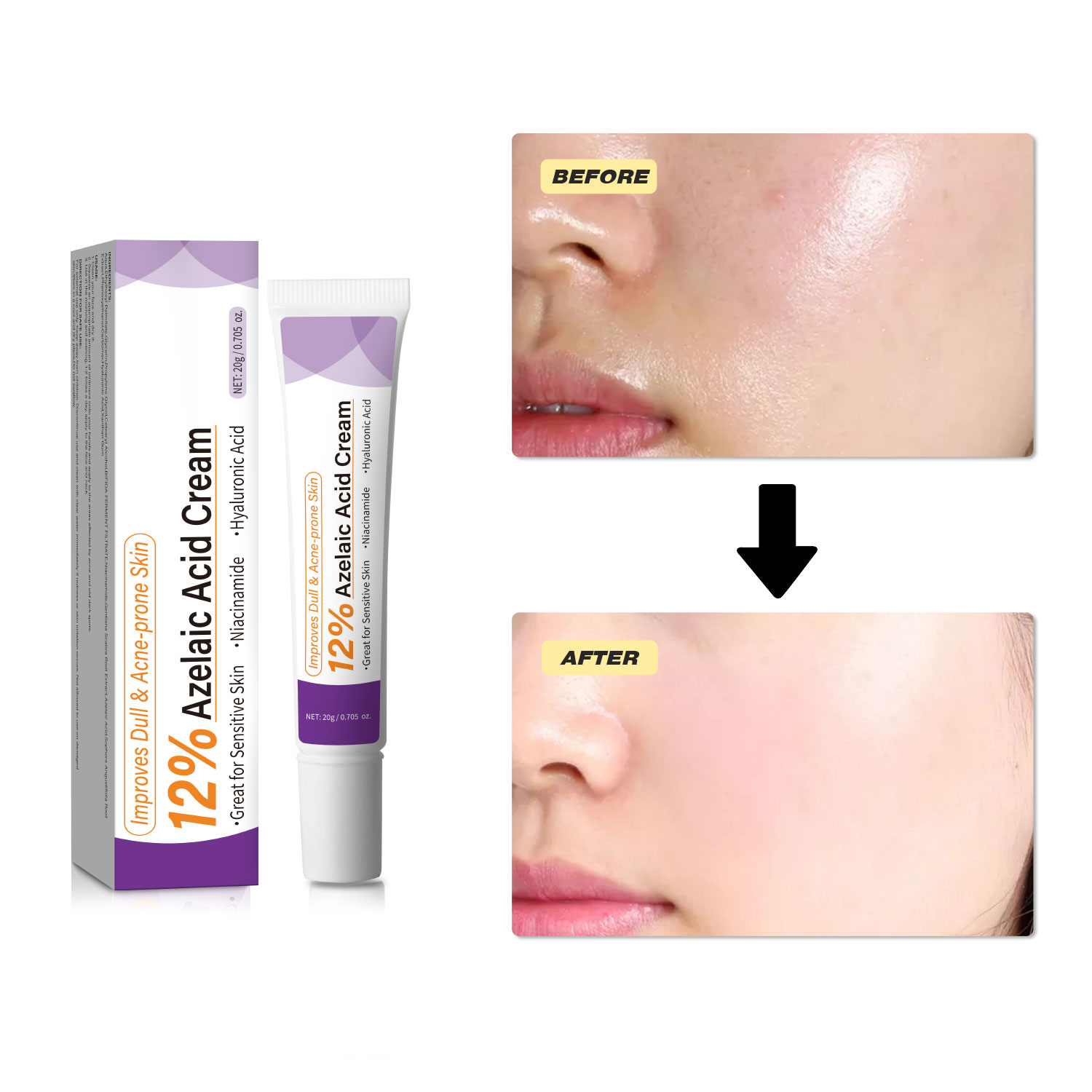 Crème à l'acide azélaïque douc - Azelaic Acid Cream avis et prix